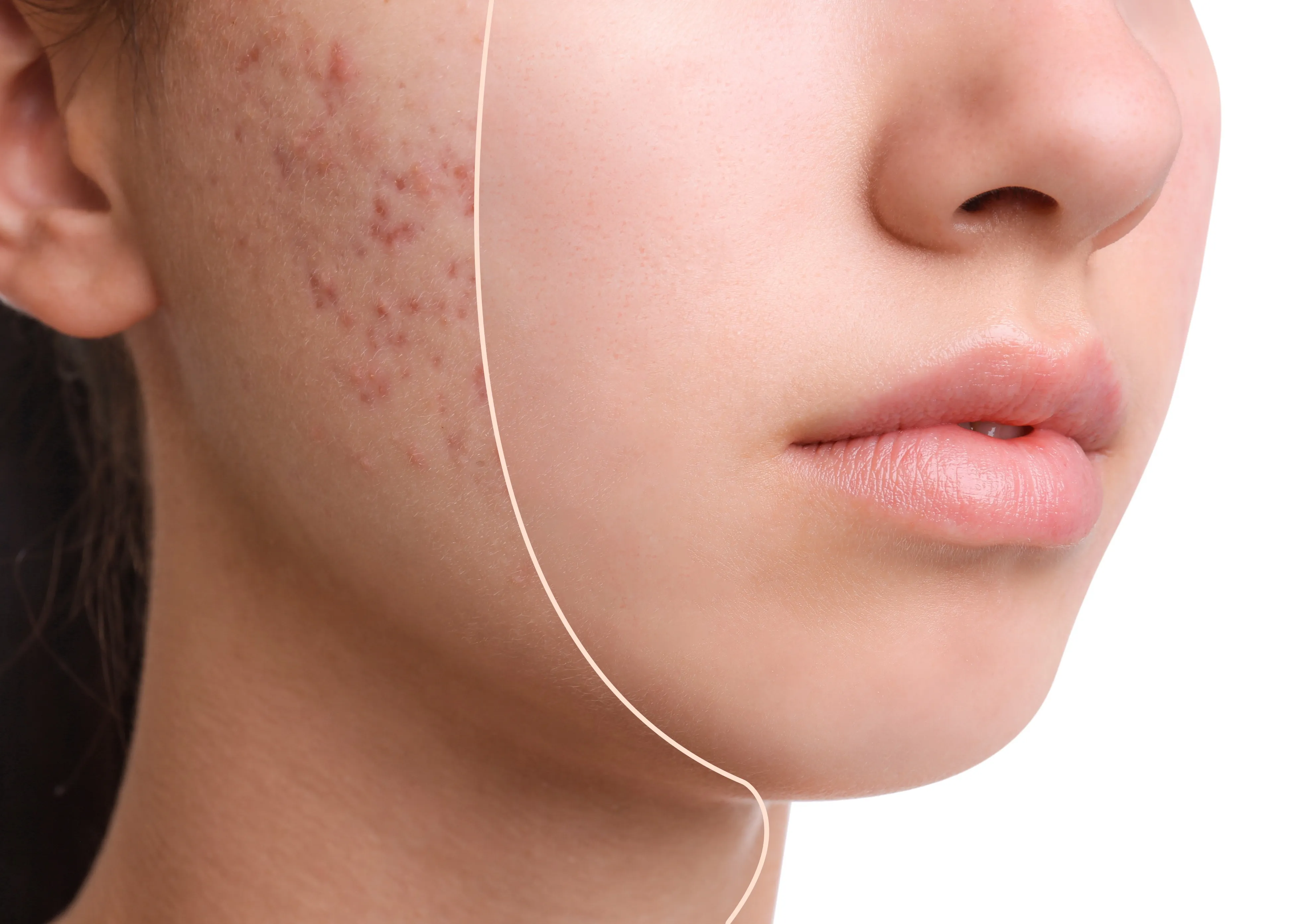 Picture of Dermatologist-Recommended Acne Treatments
